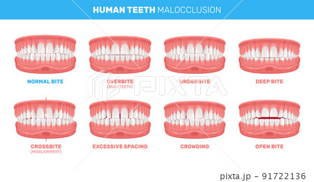 Malocclusion Of Teeth Infographics 91722136