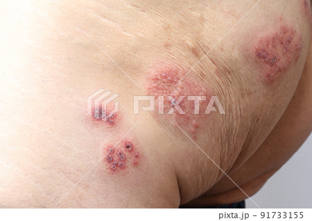 帯状疱疹 左大腿部 帯状疱疹 左大腿部 91733155