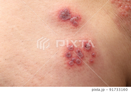 帯状疱疹　左大腿部 91733160