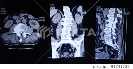 CT image of the spine of a patient with scoliosis and protrusion of the intervertebral disc. 91741286