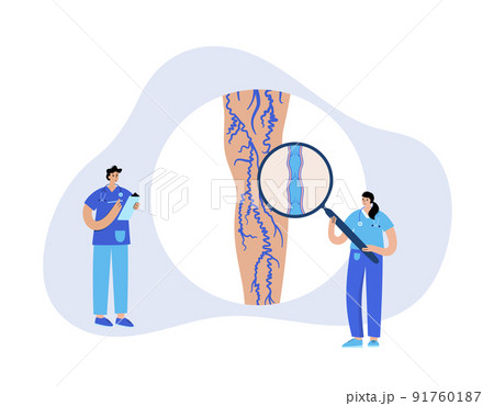 Varicose veins treatment 91760187