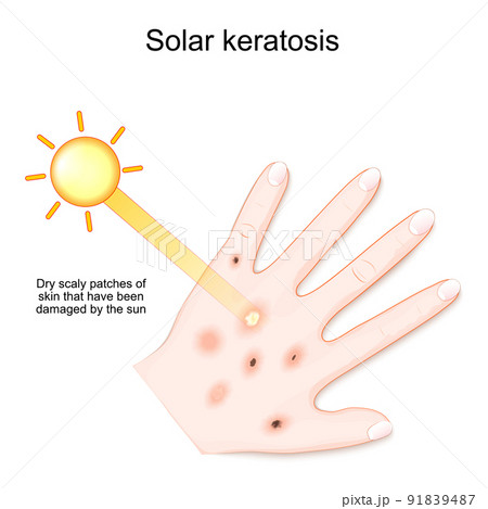 Solar keratosis. Dry scaly patches of skin 91839487
