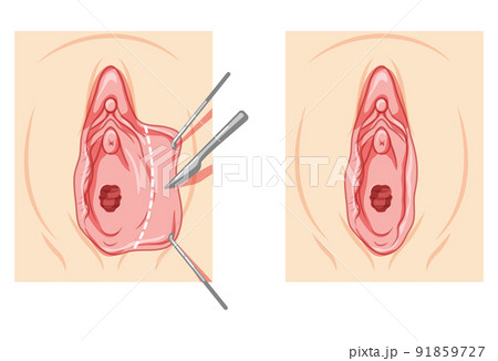 Labiaplasty Female reproductive system process and ready uterus. Vaginoplasty Front view. Human Surface anatomy perineum 91859727