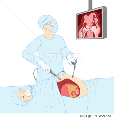 Laparoscopy keyhole surgery doctor with a patient surgical procedure Female Male reproductive system. Medical instrument 91859728