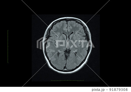 頭部のMRI画像 頭部のMRI画像 91879308