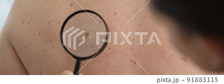 Dermatologist doctor examines birthmark of patient on back with magnifying glass Dermatologist doctor examines birthmark of patient on back with magnifying glass 91883115