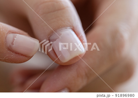 Cracked broken nail closeup. Nail weakness damage from gel polish coating. Cracked broken nail closeup. Nail weakness damage from gel polish coating. 91896980