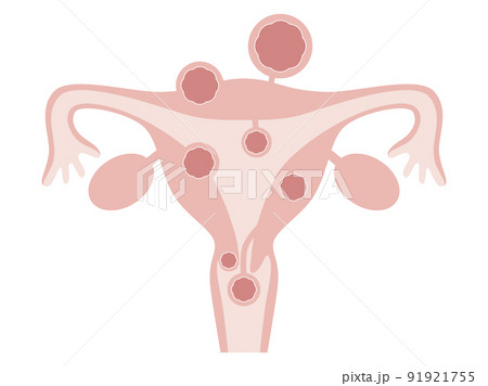 子宮筋腫の種類 91921755