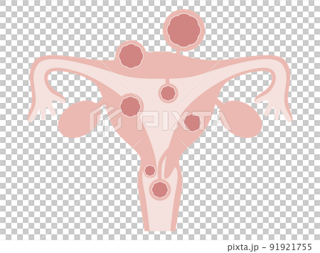 子宮筋腫の種類 91921755