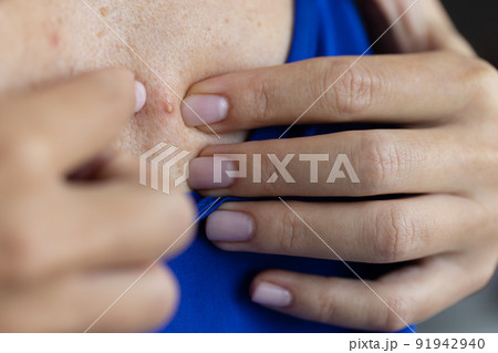 Woman try to take acne off from her chest. Closeup. Selective focus. 91942940