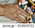 Severe gout in men suffering from joint pain, bone pain, gout, rheumatoid symptoms, radioactive sickness, ill man concept of male osteoporosis, injured bone, injury, pain, arthritis,arm, foot, knee 91943532