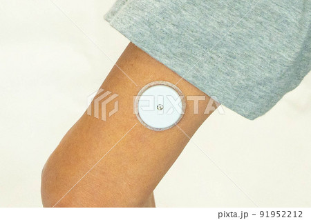 血糖グルコースモニタリング用のセンサーを二の腕裏に装着した男性 血糖グルコースモニタリング用のセンサーを二の腕裏に装着した男性 91952212