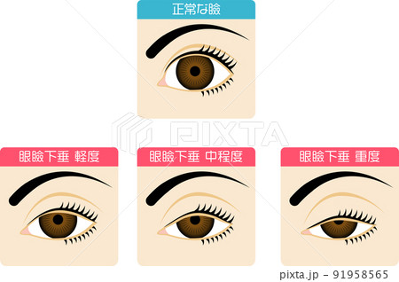 眼瞼下垂の症状を図解した素材 眼瞼下垂の症状を図解した素材 91958565