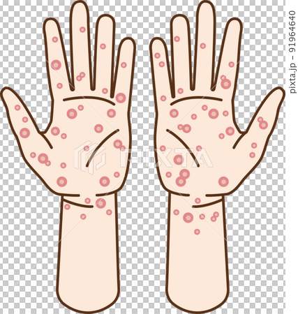Illustration of hands with syphilis and skin diseases 91964640