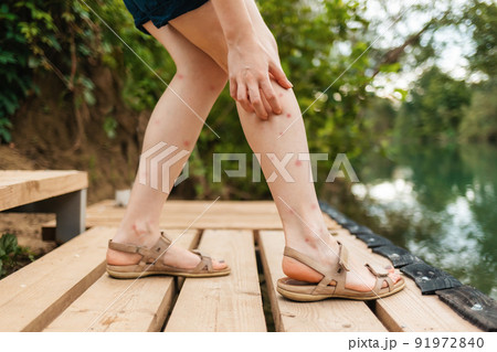 Mosquito bites. A woman scratches her bitten legs with her hands. Legs in a red rash close-up Mosquito bites. A woman scratches her bitten legs with her hands. Legs in a red rash close-up 91972840