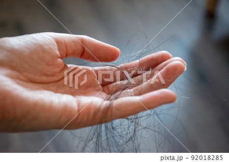 Hair loss concept. Hair loss concept. 92018285