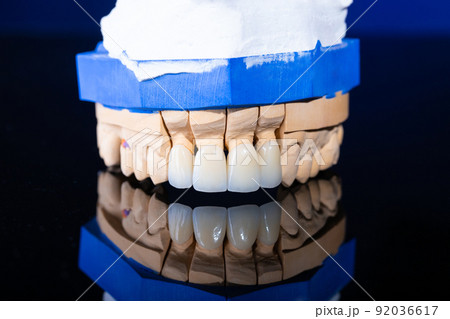 Frames of ceramic crowns on a gypsum model. Zirconia crowns. Metal-free ceramics at the manufacturing stage. Close-up, black isolate. Frames of ceramic crowns on a gypsum model. Zirconia crowns. Metal-free ceramics at the manufacturing stage. Close-up, black isolate. 92036617