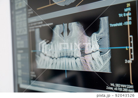 X-ray of the jaw with teeth on a computer monitor. Examination of the oral cavity using digital, medical equipment. Dental treatment in a dental clinic. 92043526