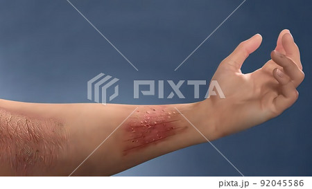 Skin sore, itching and scar 92045586