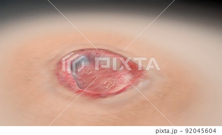 Crust and dressing following a burn or cauterization of the skin 92045604