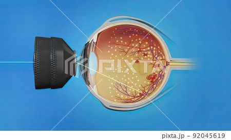 Laser surgery , eye laser treatment Laser surgery , eye laser treatment 92045619