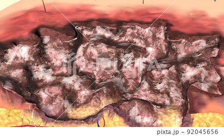 Full thickness burns are third degree burns. Full thickness burns are third degree burns. 92045656