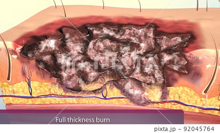 Full thickness burns are third degree burns. 92045764