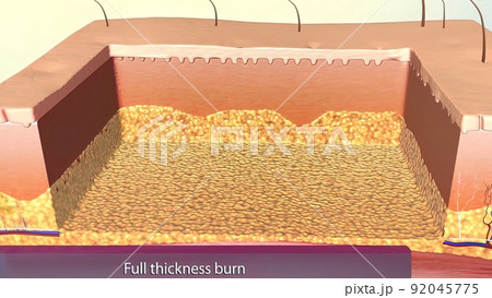 Full thickness burns are third degree burns. 92045775
