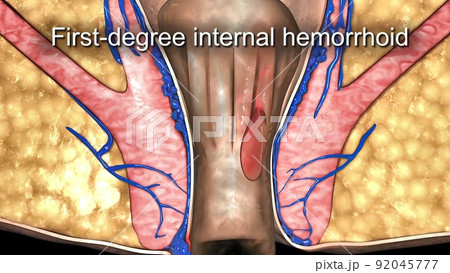 A first degree internal hemorrhoid bulges into the anal canal during bowel movements. A first degree internal hemorrhoid bulges into the anal canal during bowel movements. 92045777