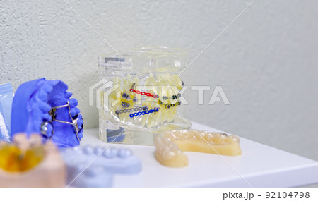 Dental model of the tooth jaw with metal braces and wire 92104798