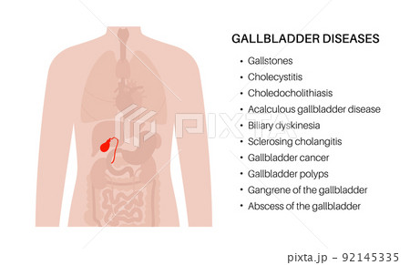 gallbladder anatomy poster 92145335