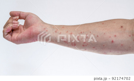 毛虫に刺されて赤く腫れる腕のアップ 92174702