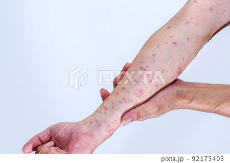 毛虫に刺されて赤く腫れる腕のアップ 毛虫に刺されて赤く腫れる腕のアップ 92175403