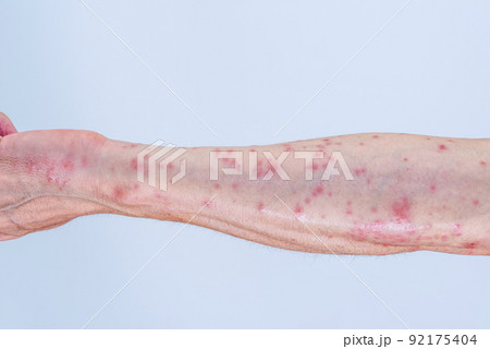 毛虫に刺されて赤く腫れる腕のアップ 毛虫に刺されて赤く腫れる腕のアップ 92175404