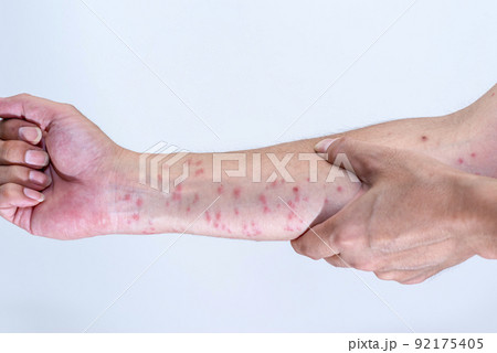 毛虫に刺されて赤く腫れる腕のアップ 毛虫に刺されて赤く腫れる腕のアップ 92175405