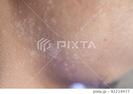 Pattern of Atopic eczema and fungal diseases on the human body. Pattern of Atopic eczema and fungal diseases on the human body. 92219477