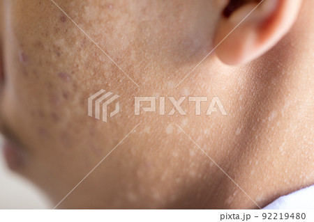 Pattern of Atopic eczema and fungal diseases on the human body. 92219480