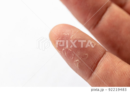 Pattern of Atopic eczema and fungal diseases on the human body. Pattern of Atopic eczema and fungal diseases on the human body. 92219483