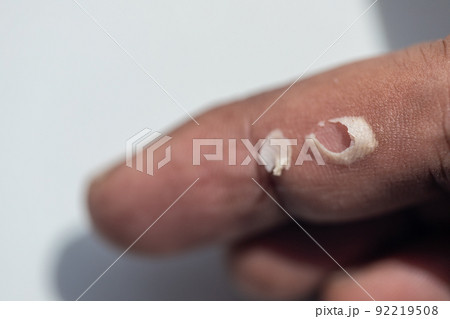 Pattern of Atopic eczema and fungal diseases on the human body. 92219508