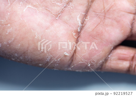 Pattern of Atopic eczema and fungal diseases on the human body. 92219527