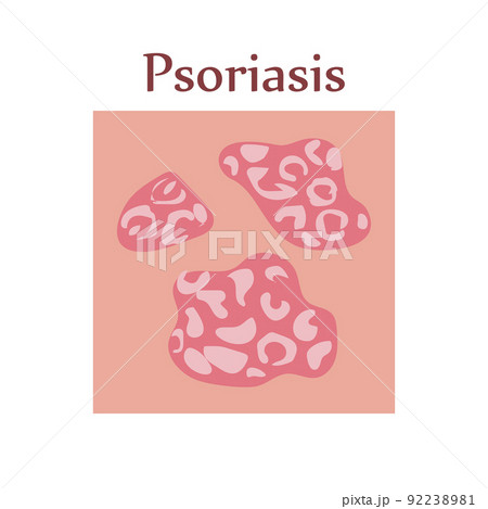 Psoriasis on human skin with itching, peeling and rash Psoriasis on human skin with itching, peeling and rash 92238981
