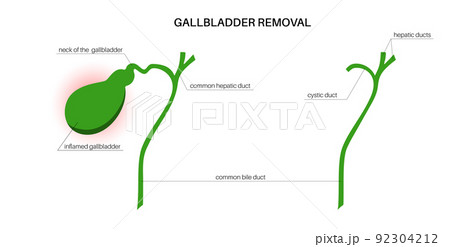 gallbladder removal surgery 92304212