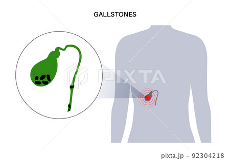 gallbladder stones anatomy 92304218