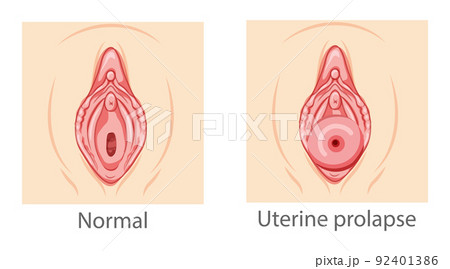 Set of uterine prolapse Female reproductive system women perineum uterus normal and with disease pain. Human anatomy 92401386