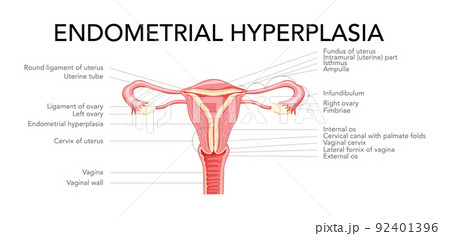 Endometrial hyperplasia Female reproductive system uterus with inscriptions medical diagram. Front view in a cut. 92401396