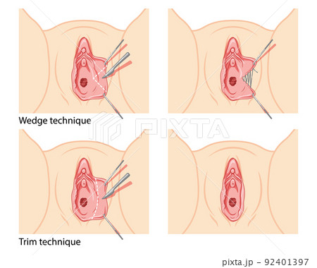 Labiaplasty Female reproductive system process and ready uterus. Vaginoplasty Front view. Human Surface anatomy perineum Labiaplasty Female reproductive system process and ready uterus. Vaginoplasty Front view. Human Surface anatomy perineum 92401397