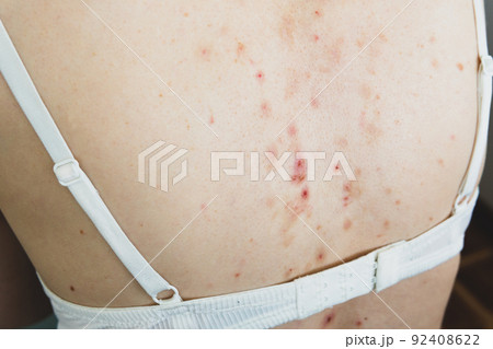 Side view of acne sequelae, torn pimples, skin itching on the back. 92408622