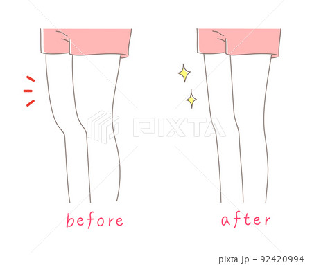 太ももが太い女性と細い女性のイラスト素材 太ももが太い女性と細い女性のイラスト素材 92420994