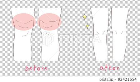 腿粗的女人和腿細的女人的插圖素材 腿粗的女人和腿細的女人的插圖素材 92421654