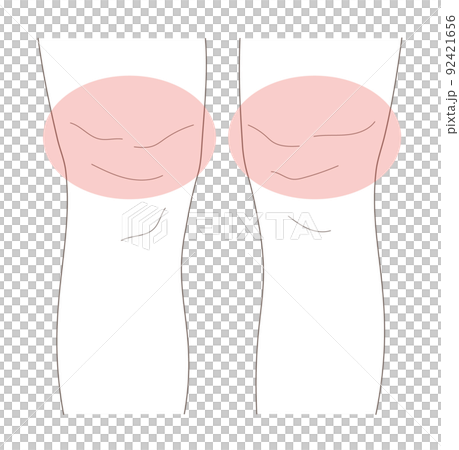 一個腿粗的女人的插圖素材 一個腿粗的女人的插圖素材 92421656